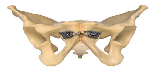 Innovative Kabel-Klammer-Implantate zur Behandlung von Verletzungen des vorderen Beckenrings